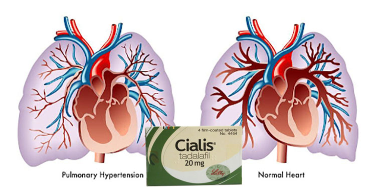 治療肺動脈高壓 治療肺動脈高壓