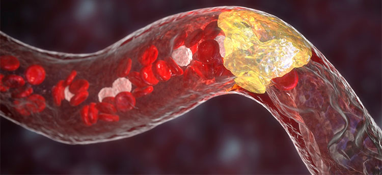 血脂過高影響陰莖勃起狀態 血脂過高影響陰莖勃起狀態